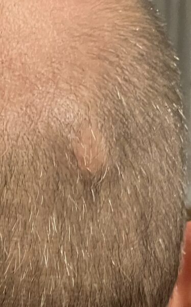 Cyst Removal Before Cyst Removal Before