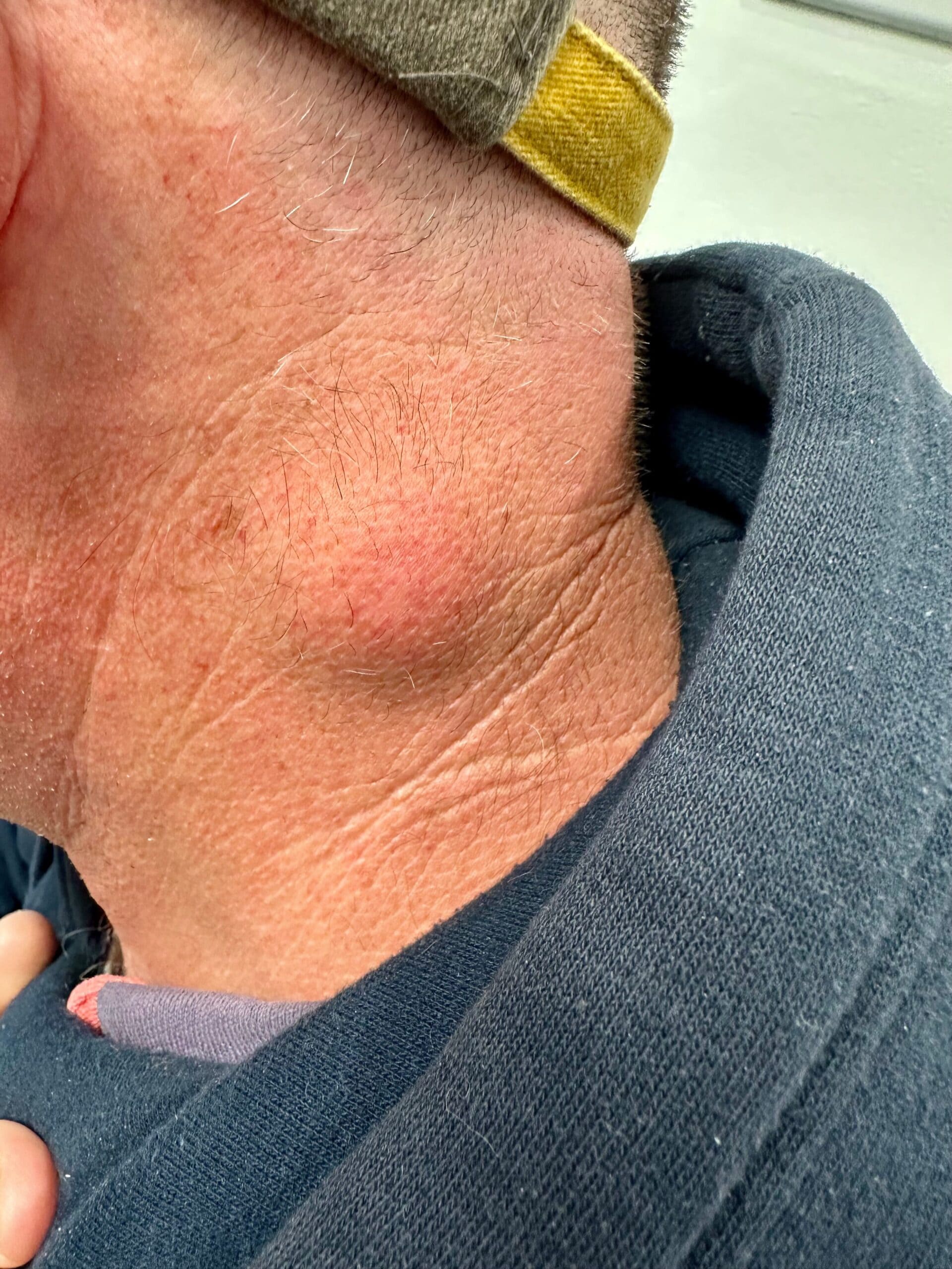 Mole-after-2 (1) (1) Mole-after-2 (1) (1)