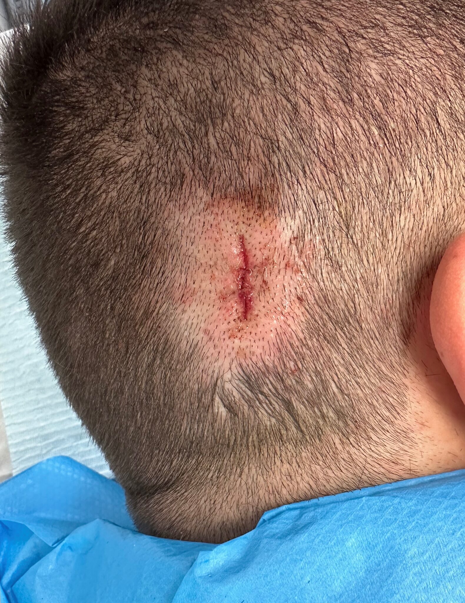 Skin Tag removal (1)