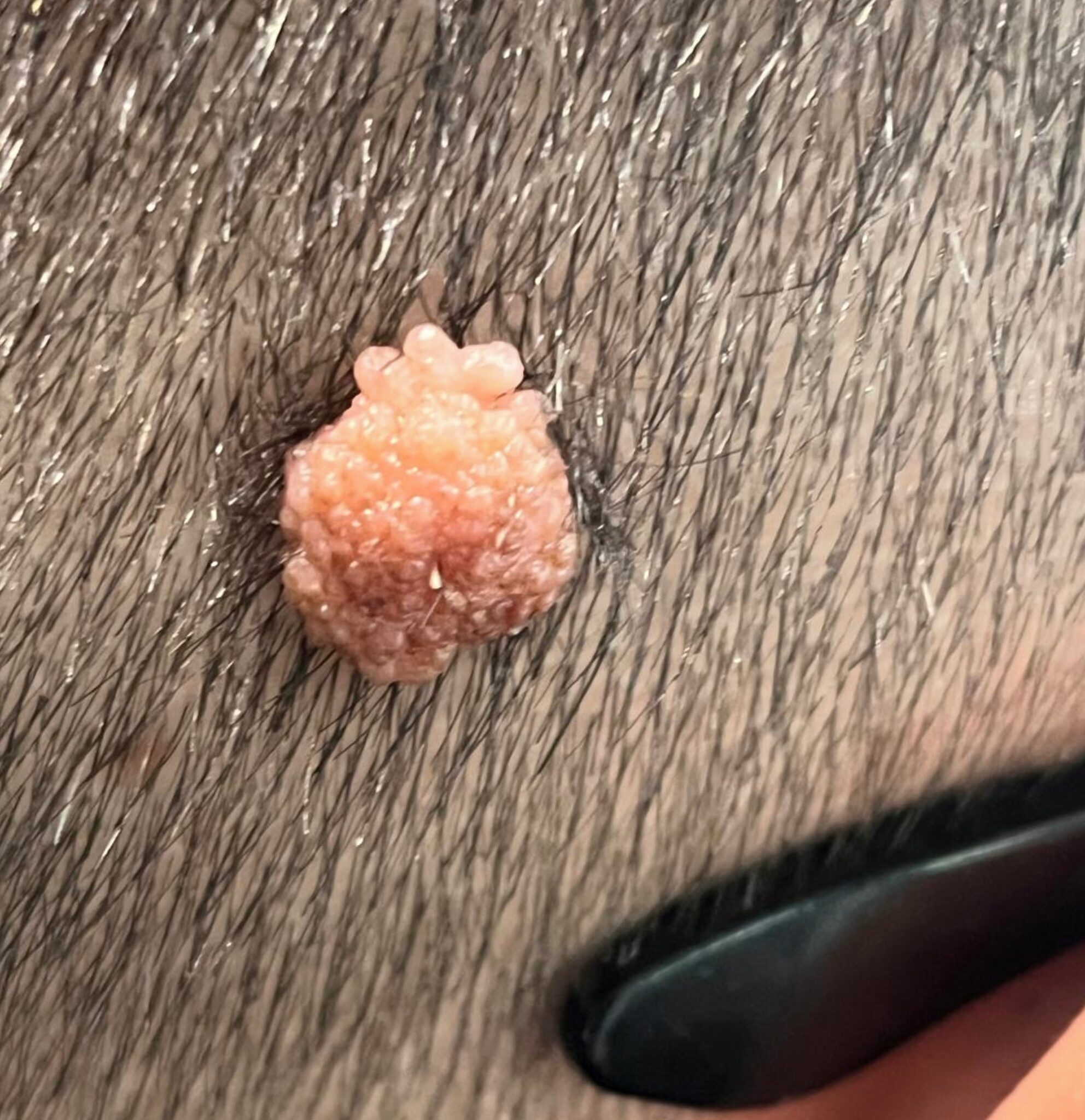 Skin Tag removal Skin Tag removal