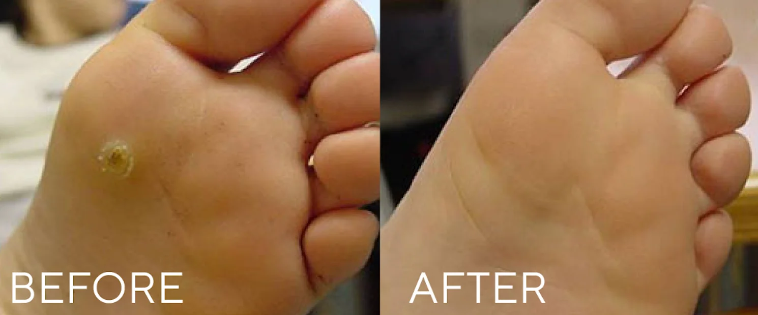 Before and after CryoClear treatment on foot showing wart removal and healed skin