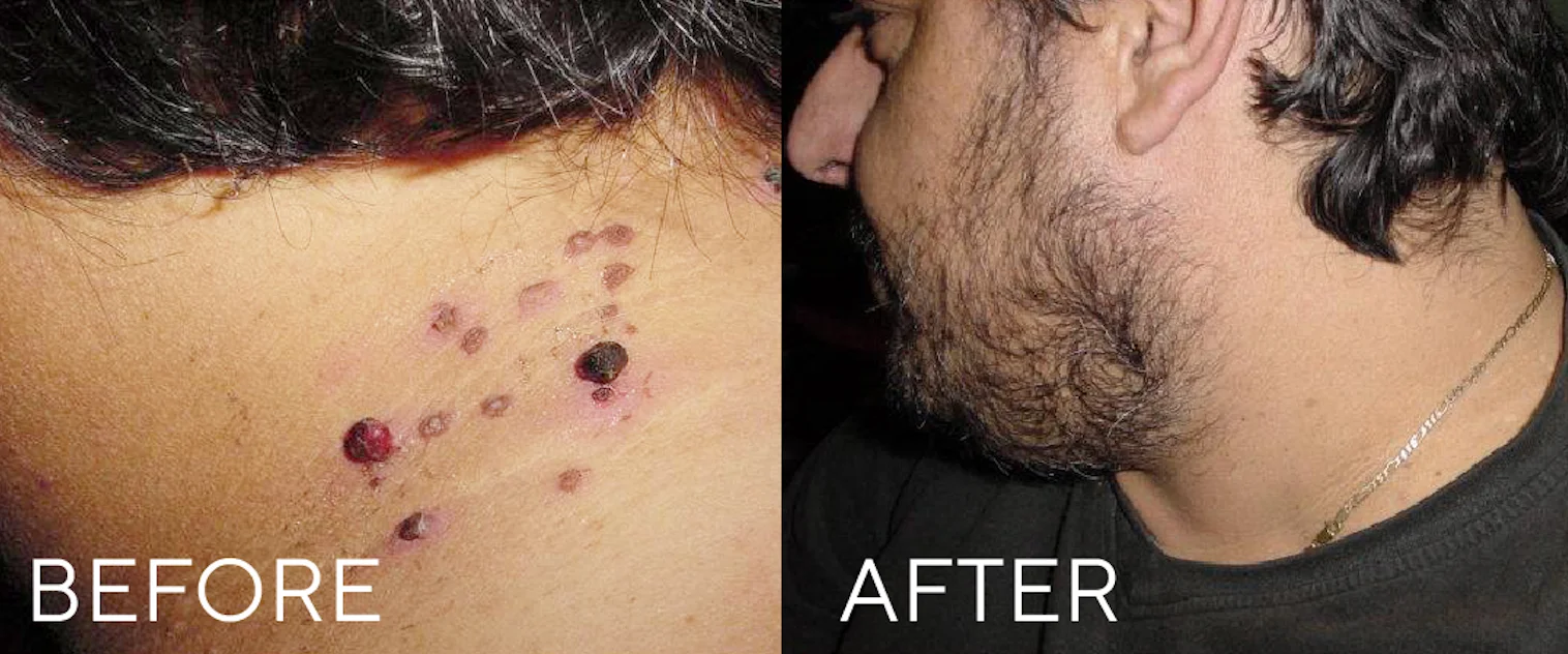 Before and after CryoClear treatment on neck showing removal of multiple skin lesions