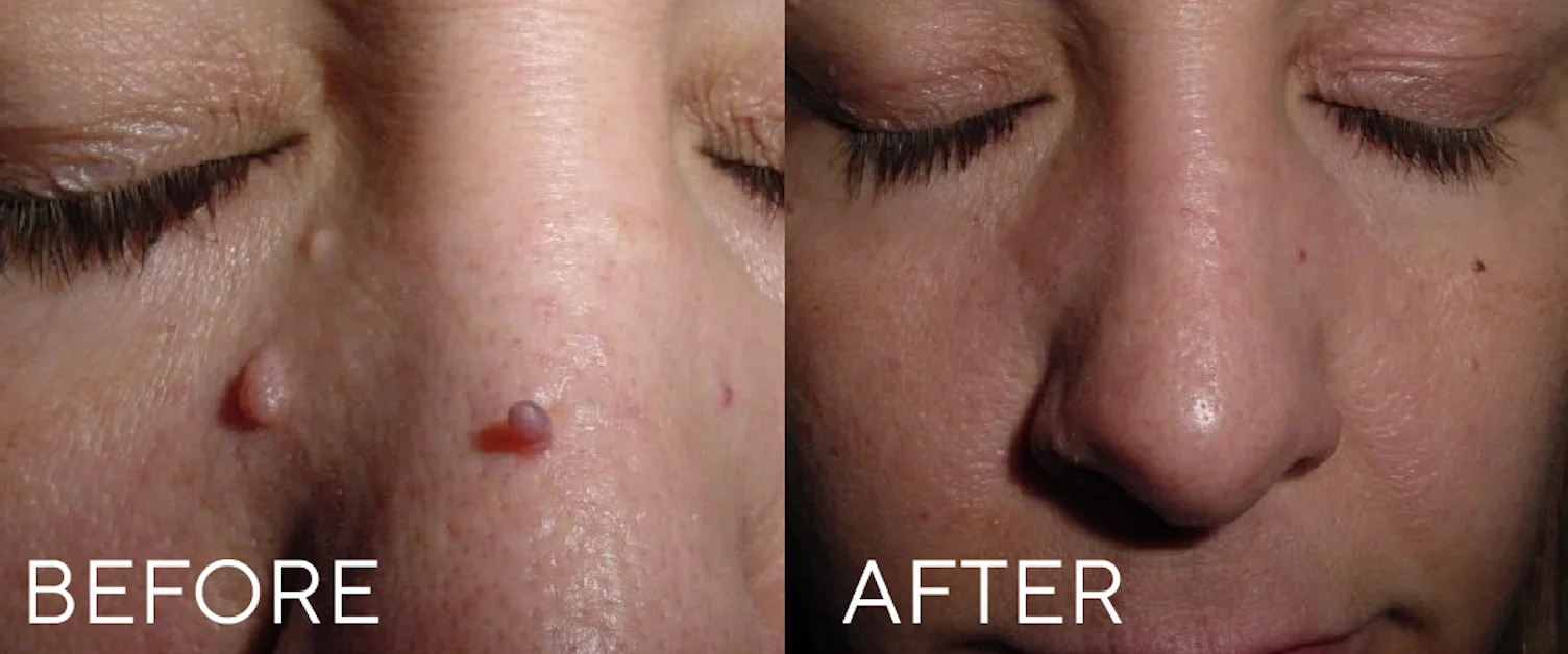 Before and after CryoClear treatment on nose showing removal of benign skin growths