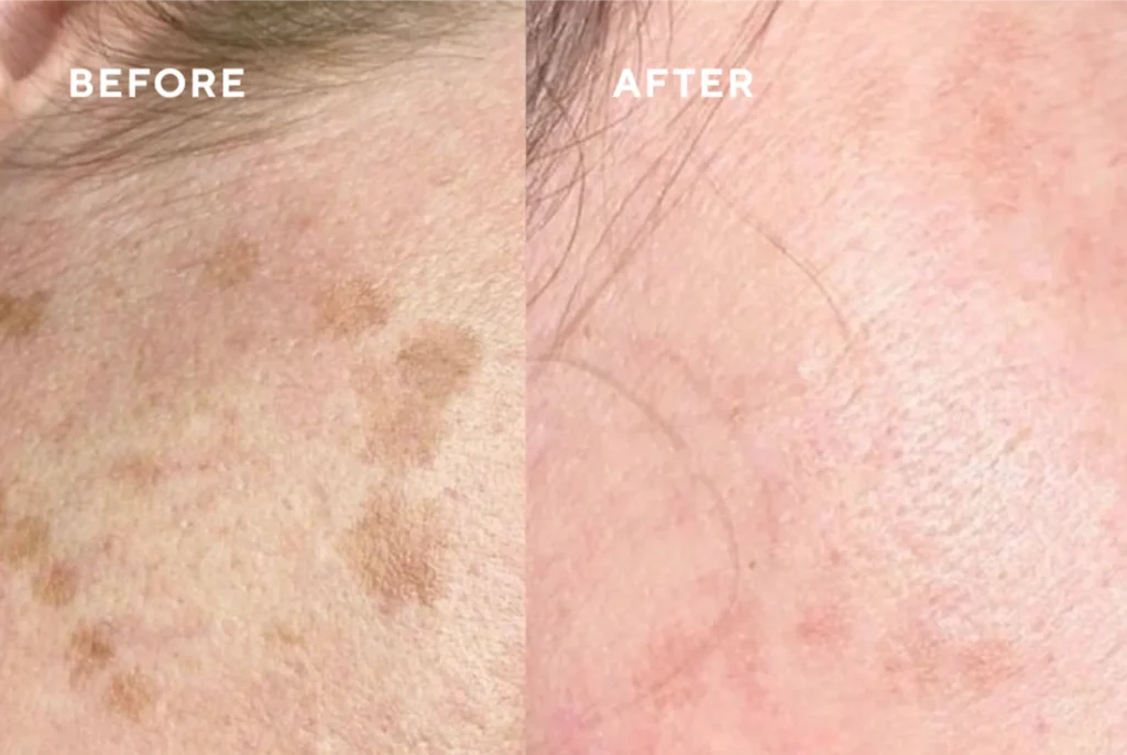 Before and after CryoClear treatment showing improved skin tone and reduced pigmentation