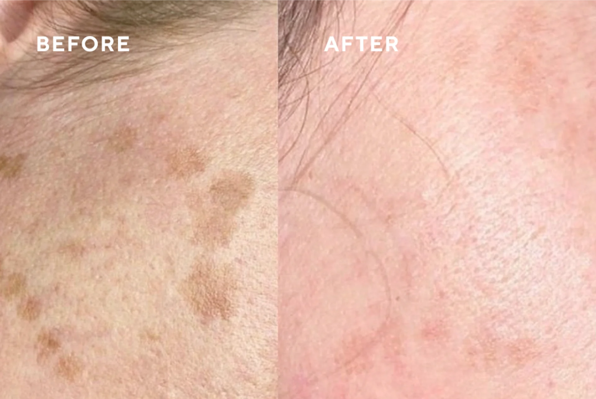 Before and after CryoClear treatment showing improved skin tone and reduced pigmentation