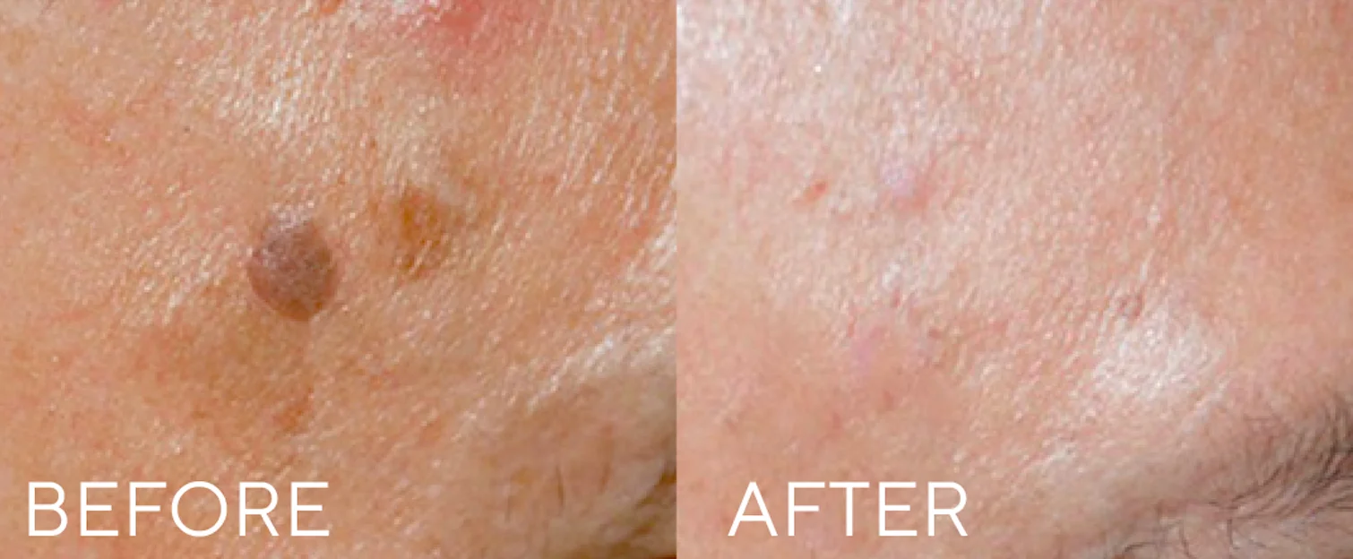 Before and after CryoClear treatment showing removal of a raised mole and smoother skin texture
